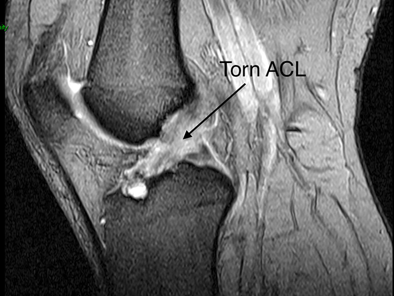 imahe showing MRI Scan showing torn Anterior Cruciate Ligament (ACL) knee sports injuries consultant Mr Aslam Mohammed 25 years experience in treating meniscal tears in high level atheltics   knee injuries